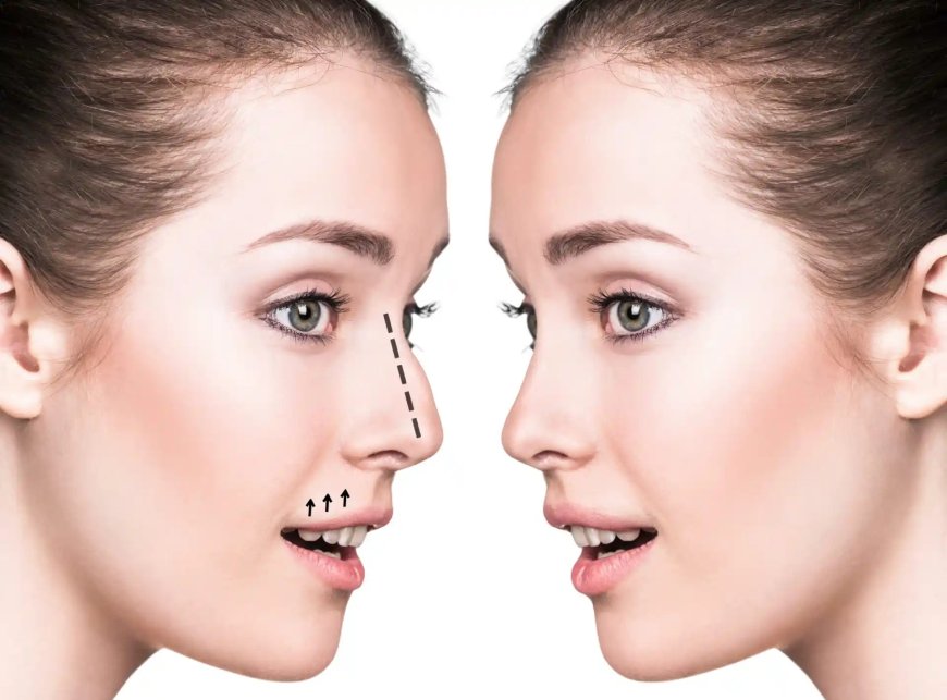 Best Rhinoplasty Surgeons in Dubai: From Assessment to Recovery