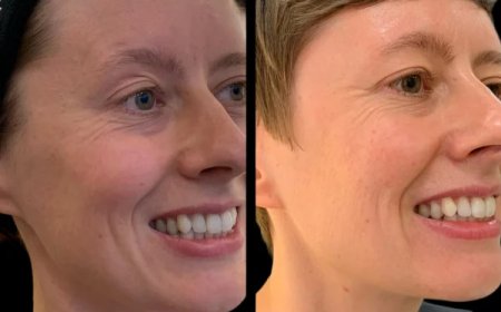 Best Plastic Surgeon in Dubai for Comprehensive Profhilo Review