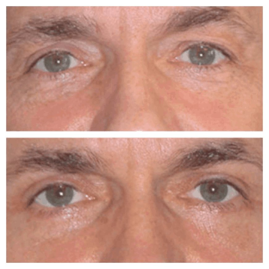 Dry Eyes After Surgery | Best Eye bag removal Surgeons in dubai