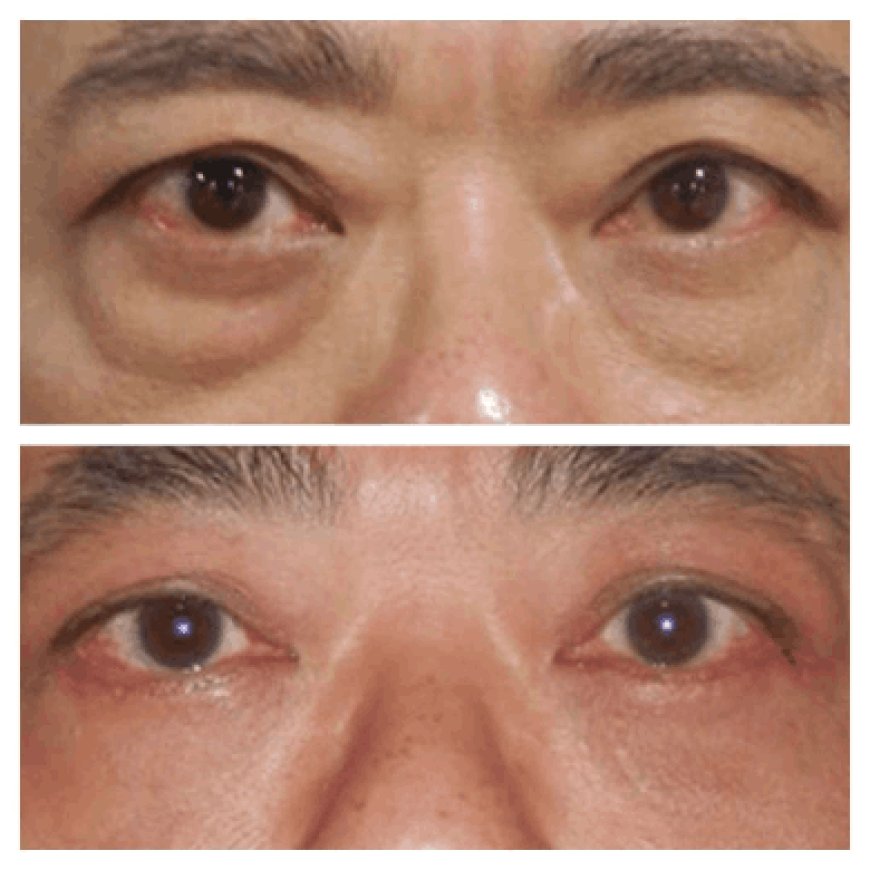 Eye bag removal in Dubai: Pain and anesthesia