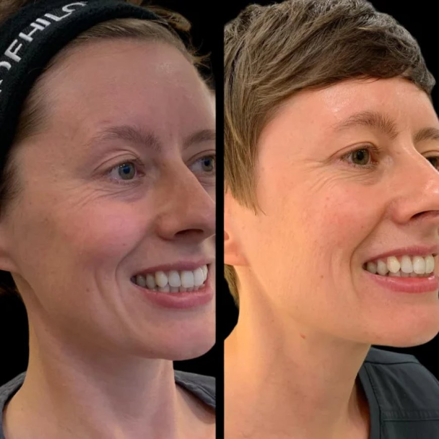 Best Plastic Surgeon in Dubai for Comprehensive Profhilo Review