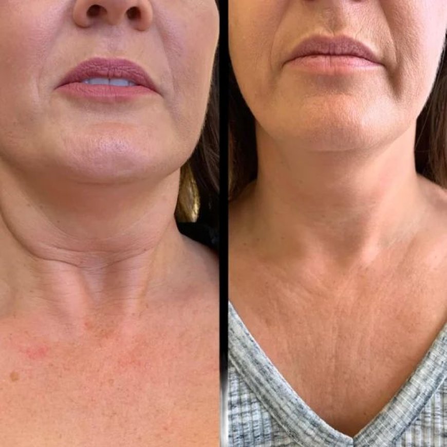 Who Benefits Most from Profhilo Treatment in Dubai?